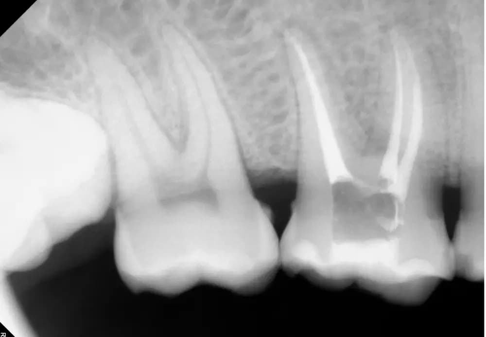 Endodoncia